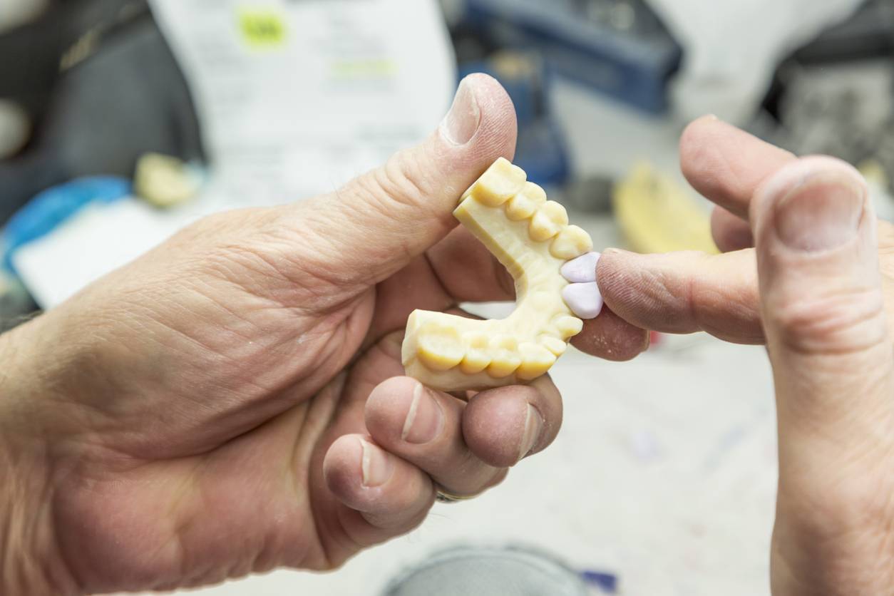 prothésiste dentaire impression 3D
